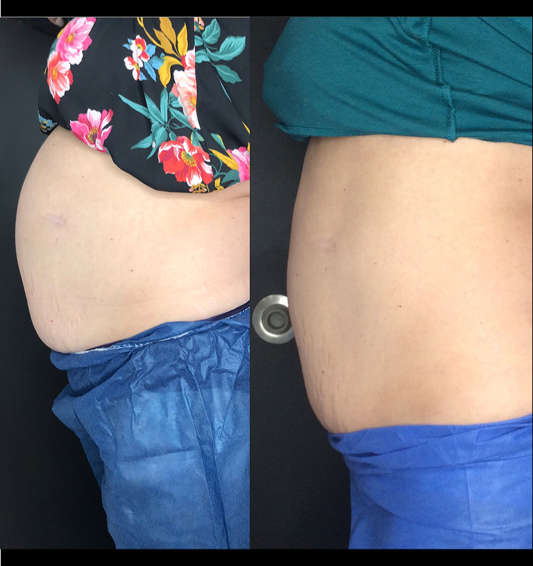 Coolsculpting