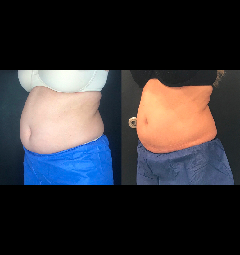 Coolsculpting