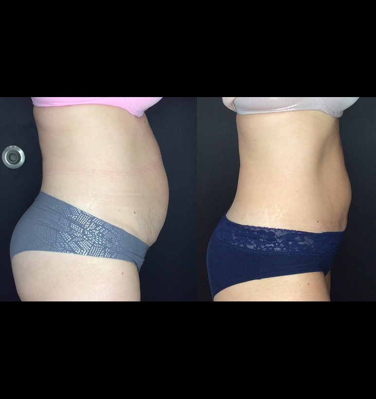 Coolsculpting