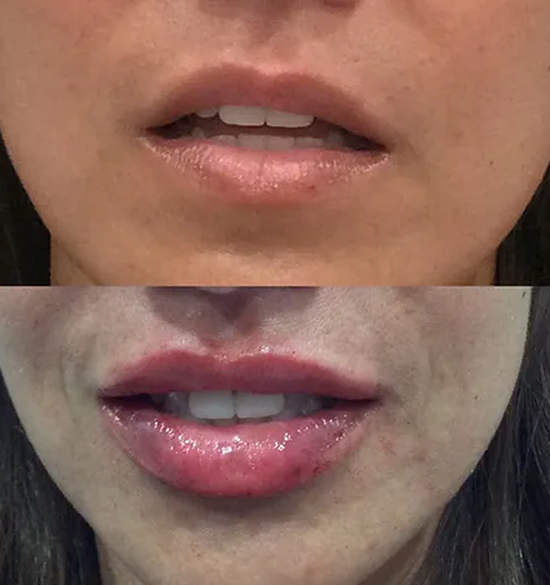Lip Filler