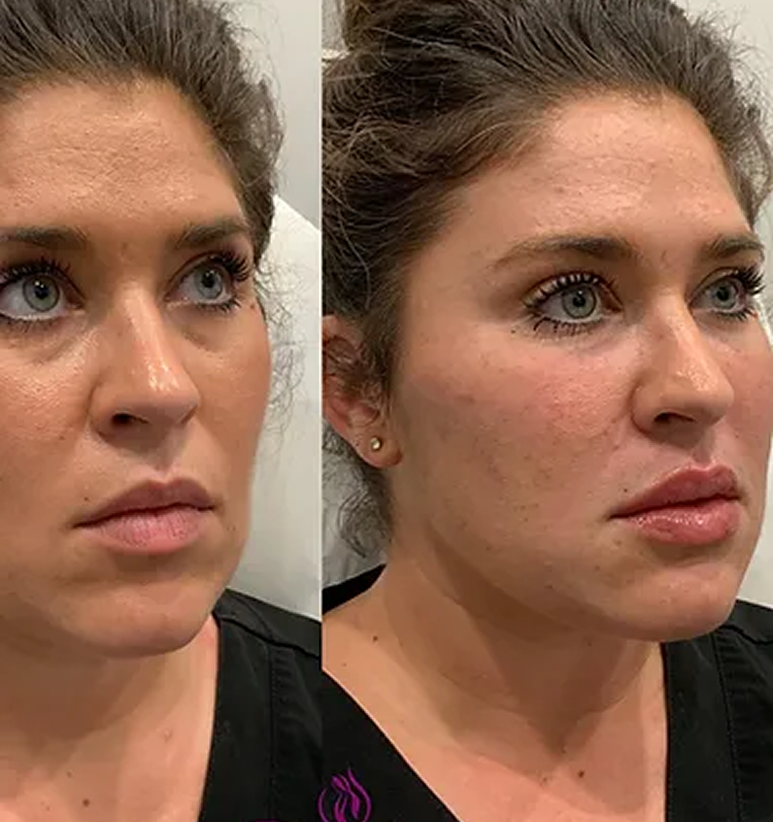 Lip Filler