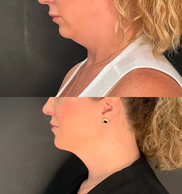 Chin Filler