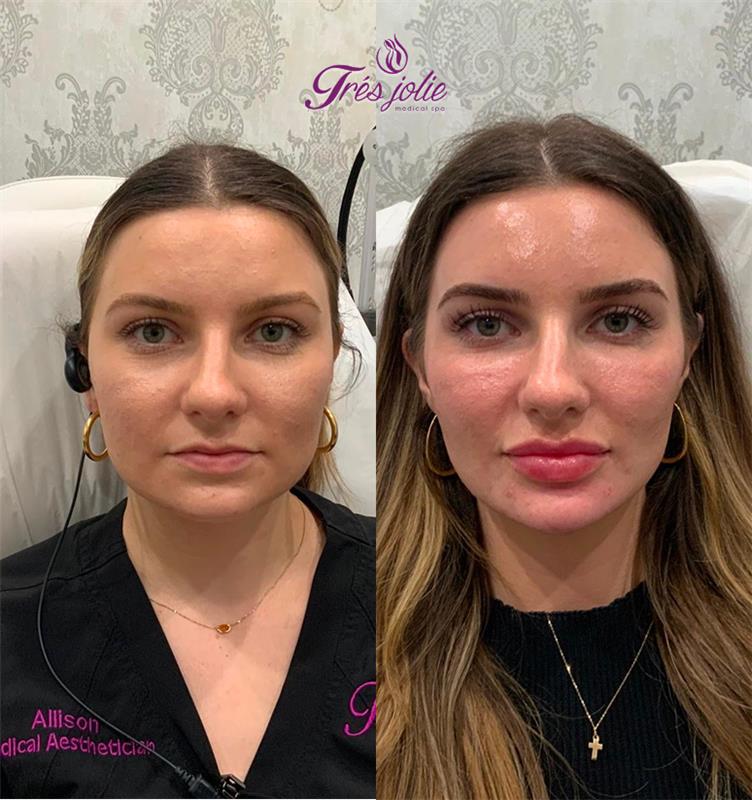 Chin Filler