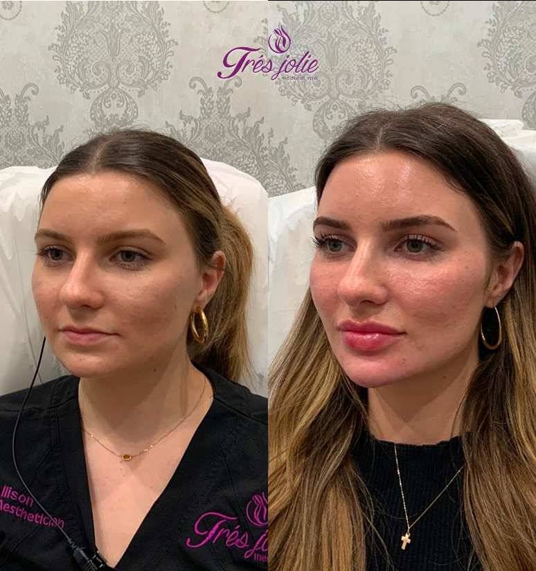 Chin Filler