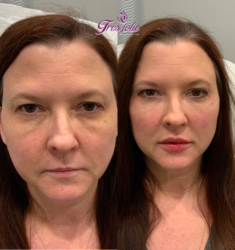 Undereyes