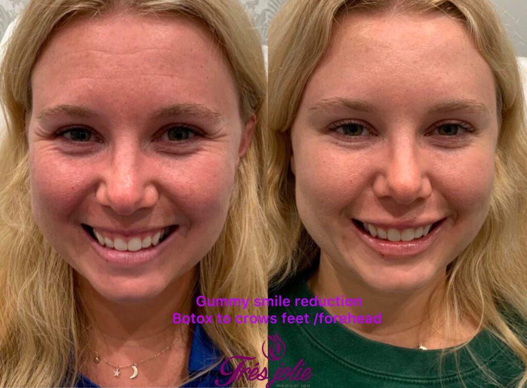Botox/Dysport