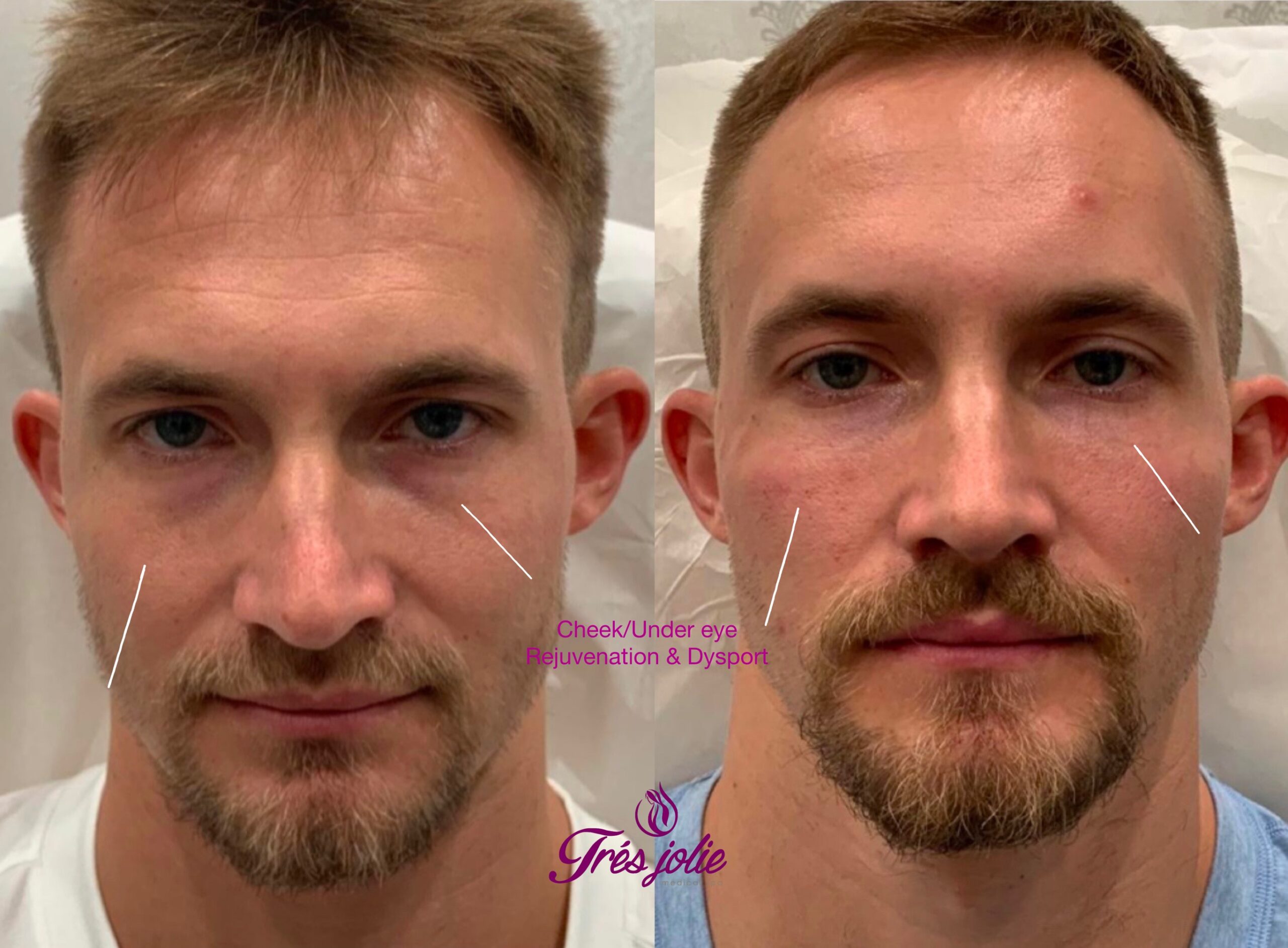 Filler/Botox/Dysport