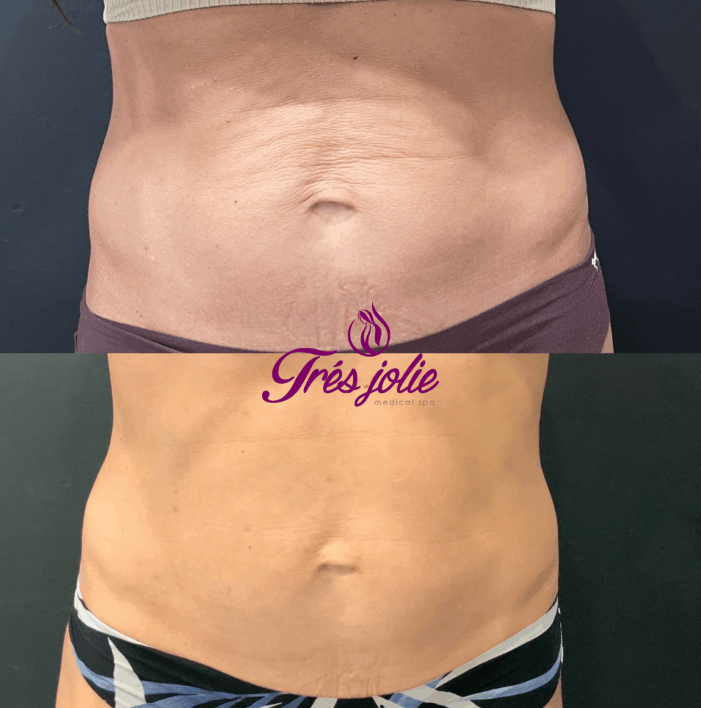 Genius Micro-needling RF