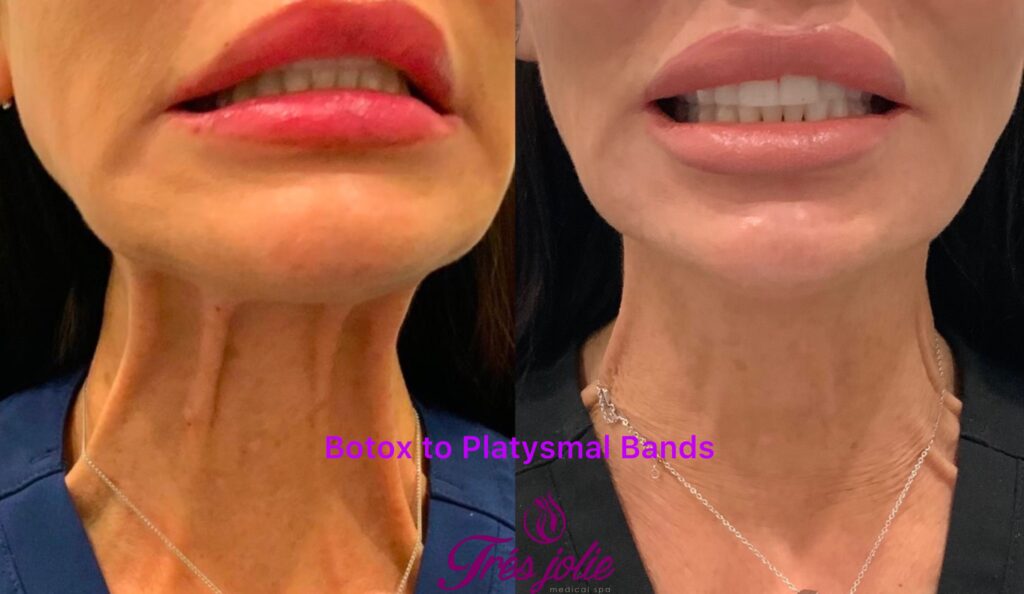 Botox/Dysport
