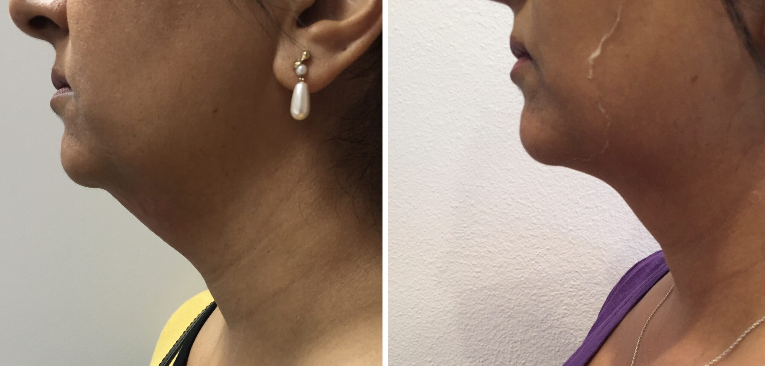 Kybella