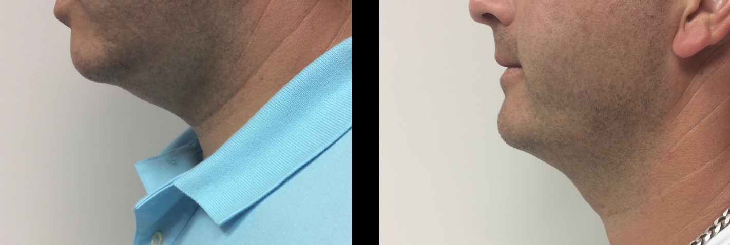 Kybella