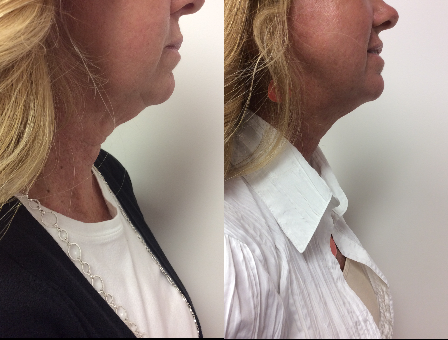 Kybella